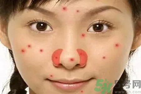 鼻翼長(zhǎng)痘痘怎么回事？鼻翼長(zhǎng)痘痘的原因是什么？