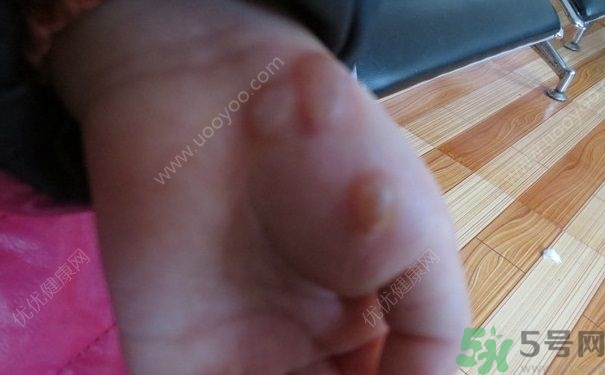 15歲還會得手足口病嗎？手足口病的癥狀有哪些？