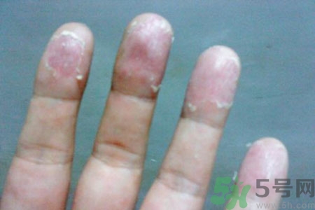 ?手掌脫皮的危害有哪些？如何預(yù)防手掌脫皮？