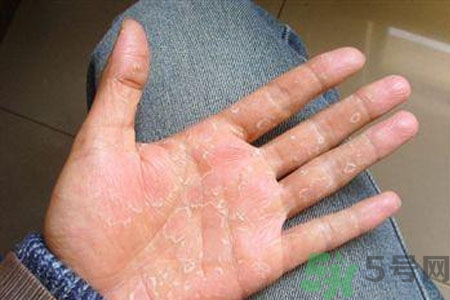 ?手掌脫皮的危害有哪些？如何預(yù)防手掌脫皮？