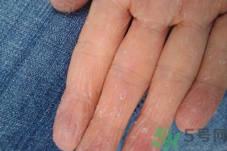 ?手掌脫皮的危害有哪些？如何預(yù)防手掌脫皮？