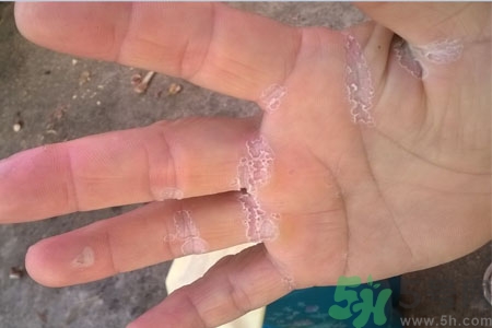 手脫皮是什么原因？手脫皮的治療方法是什么？