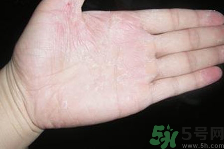 手脫皮是什么原因？手脫皮的治療方法是什么？