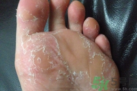 腳脫皮是怎么回事？腳脫皮怎么辦？