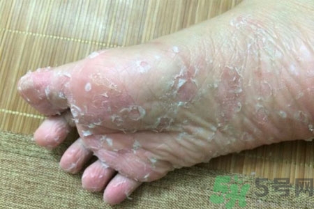 腳脫皮的治療方法有哪些？如何預(yù)防腳脫皮？