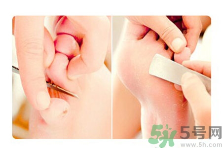 雞眼如何去除？腳上長(zhǎng)了雞眼怎么治療？