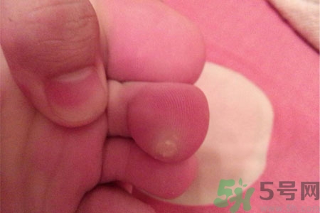 雞眼如何去除？腳上長(zhǎng)了雞眼怎么治療？
