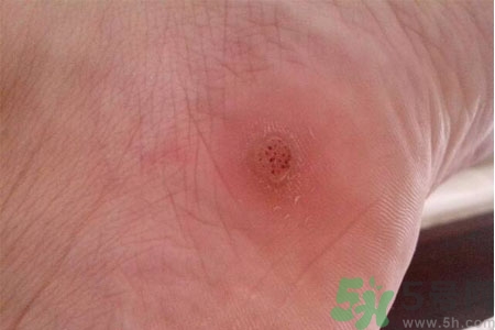 腳上長雞眼是怎么回事？腳上長雞眼是怎么辦？