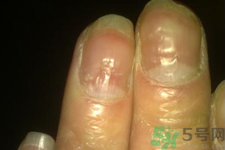 孩子手指甲凹凸不平是什么原因？手指甲凹凸不平的原因是什么？