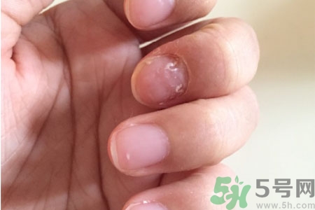孩子手指甲凹凸不平是什么原因？手指甲凹凸不平的原因是什么？
