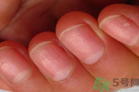 手指甲凹凸不平是怎么回事？如何預(yù)防手指甲凹凸不平？