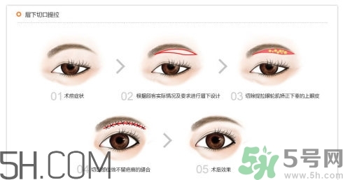 切眉手術(shù)后老得快嗎？切眉能保持多久？