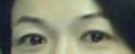 提眉術(shù)后多久可以恢復(fù)？提眉術(shù)后全過(guò)程照片
