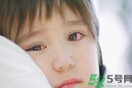 流行性腮腺炎的表現(xiàn)有哪些？?流行性腮腺炎飲食怎么調(diào)理？