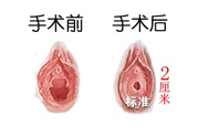處女膜修補(bǔ)術(shù)效果怎么樣？處女膜修復(fù)手術(shù)有風(fēng)險(xiǎn)嗎？