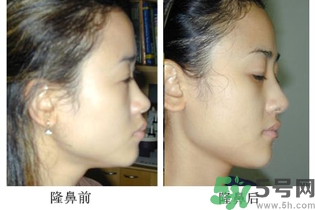 玻尿酸隆鼻的危害有哪些？玻尿酸隆鼻的副作用是什么？