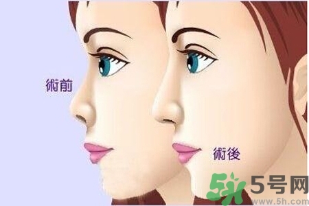 玻尿酸隆鼻的缺點(diǎn)是什么？玻尿酸隆鼻的優(yōu)點(diǎn)有哪些？