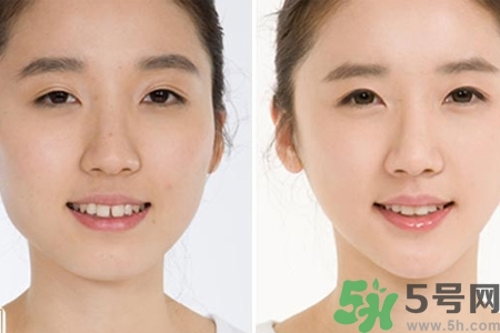 玻尿酸隆鼻的缺點(diǎn)是什么？玻尿酸隆鼻的優(yōu)點(diǎn)有哪些？