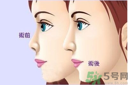 玻尿酸隆鼻和手術(shù)隆鼻的區(qū)別是什么？