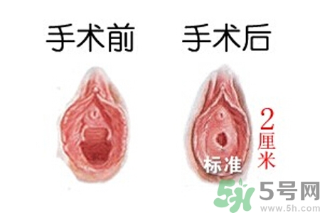 什么人不能做處女膜修補術(shù)？處女膜修補術(shù)會留疤嗎？
