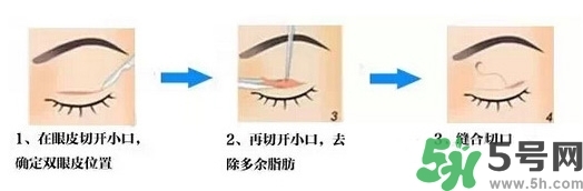 雙眼皮手術(shù)哪種最好？割雙眼皮后注意些什么？