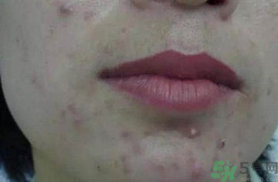 什么樣的痘痘能擠？哪些痘痘不能擠？