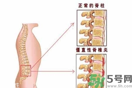 僵直性脊椎炎的癥狀有哪些？怎樣預(yù)防僵直性脊椎炎？