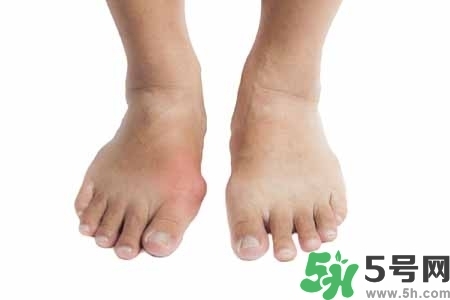 引發(fā)痛風(fēng)的原因是什么？痛風(fēng)病人飲食需注意什么好？