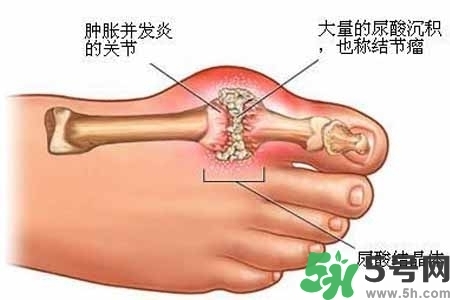引發(fā)痛風(fēng)的原因是什么？痛風(fēng)病人飲食需注意什么好？