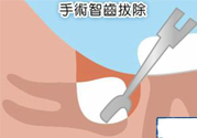智齒拔完后有個(gè)洞怎么辦？拔智齒后有個(gè)洞多久能長(zhǎng)好？