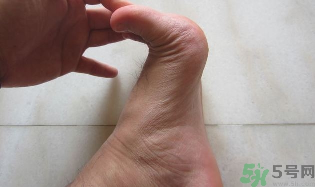 腳拇指外翻遺傳嗎？腳拇指外翻怎么矯正？