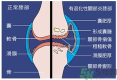 骨關(guān)節(jié)炎能治好嗎？骨關(guān)節(jié)炎平時注意事項