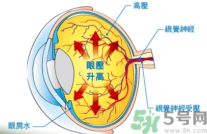 青光眼可以治愈嗎？青光眼怎樣治療？