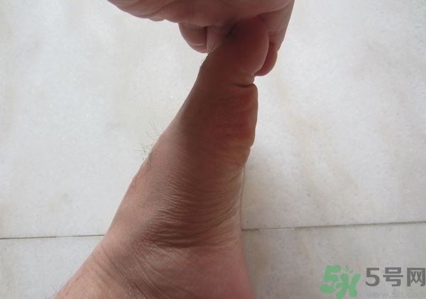 腳拇指外翻遺傳嗎？腳拇指外翻怎么矯正？