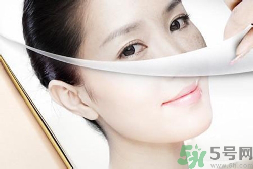 曬斑可以自己消退嗎？曬斑可以用激光去除嗎？