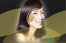 曬斑可以自己消退嗎？曬斑可以用激光去除嗎？