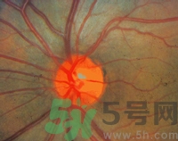 青光眼可以治愈嗎？青光眼怎樣治療？