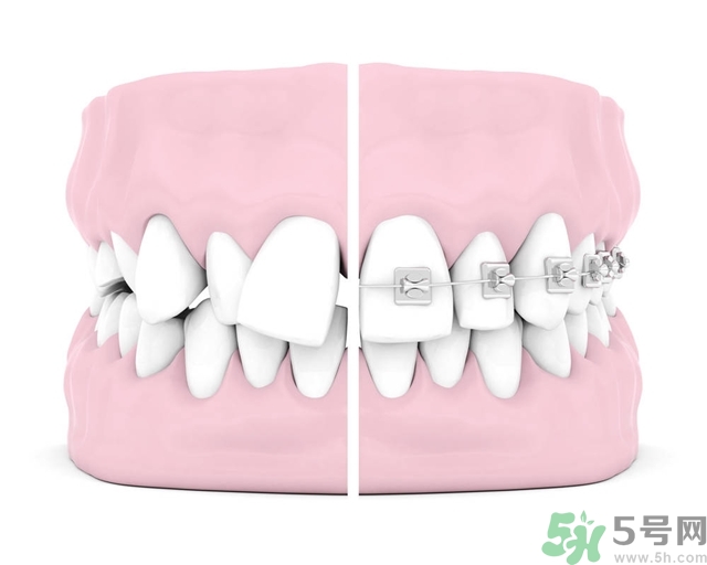 牙齒橫著長(zhǎng)怎么辦？智齒橫著長(zhǎng)一定要拔嗎？