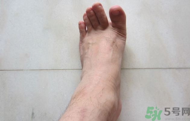腳拇指外翻遺傳嗎？腳拇指外翻怎么矯正？