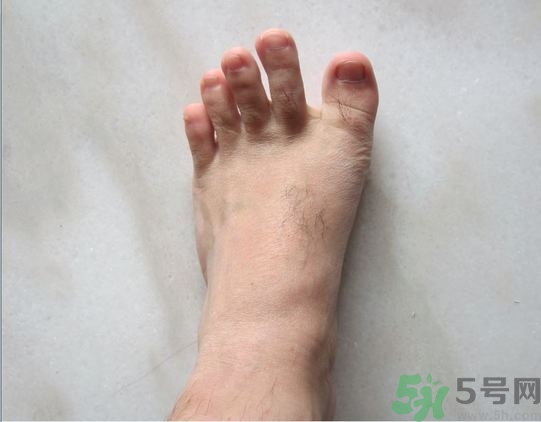 腳拇指外翻遺傳嗎？腳拇指外翻怎么矯正？