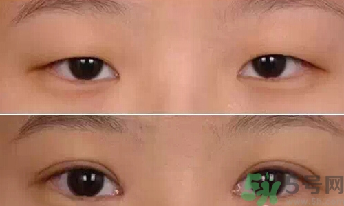 天生腫眼泡怎么消除？天生腫眼泡怎么辦？