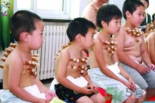 小孩可以拔罐嗎？寶寶能拔火罐嗎？