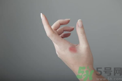 手被燙紅了怎么辦？手被燙了怎么止痛？