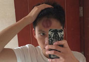 頭痛可以在額頭上拔火罐嗎？額頭上拔火罐有什么好處？