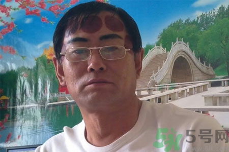 頭痛可以在額頭上拔火罐嗎？額頭上拔火罐有什么好處？
