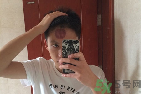 頭痛可以在額頭上拔火罐嗎？額頭上拔火罐有什么好處？