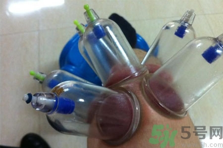 膝蓋能拔罐嗎？膝蓋疼可以拔罐嗎？