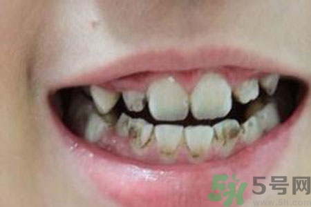 小孩牙齒發(fā)黑怎么回事？小孩牙齒發(fā)黑怎么辦？