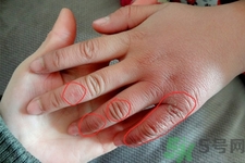 長(zhǎng)凍瘡可以擦風(fēng)油精嗎？風(fēng)油精對(duì)凍瘡真的有效嗎？