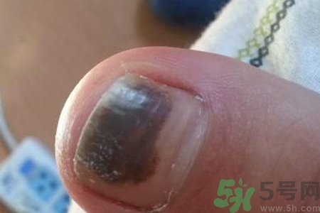 腳趾甲變黑是什么原因？腳趾甲變黑是怎么回事？